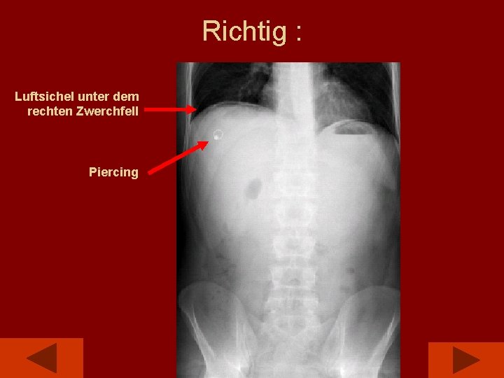 Richtig : Luftsichel unter dem rechten Zwerchfell Piercing 