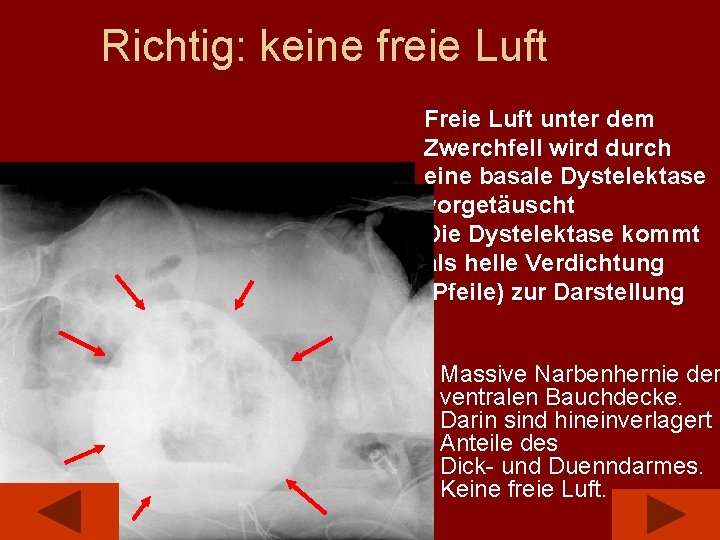 Richtig: keine freie Luft Freie Luft unter dem Zwerchfell wird durch eine basale Dystelektase