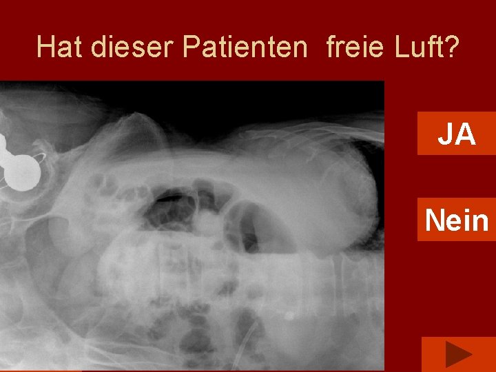 Hat dieser Patienten freie Luft? JA Nein 