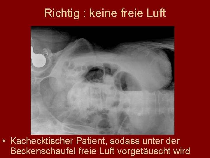 Richtig : keine freie Luft • Kachecktischer Patient, sodass unter der Beckenschaufel freie Luft