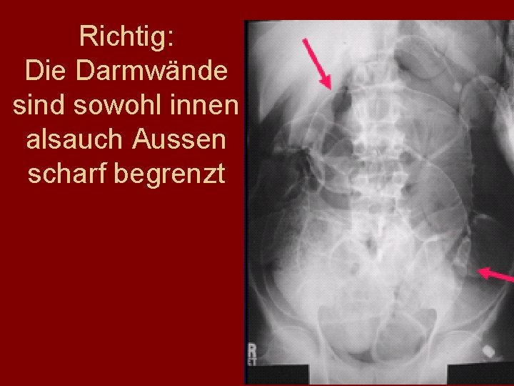 Richtig: Die Darmwände sind sowohl innen alsauch Aussen scharf begrenzt 
