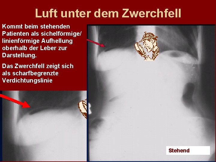 Luft unter dem Zwerchfell Kommt beim stehenden Patienten als sichelförmige/ linienförmige Aufhellung oberhalb der