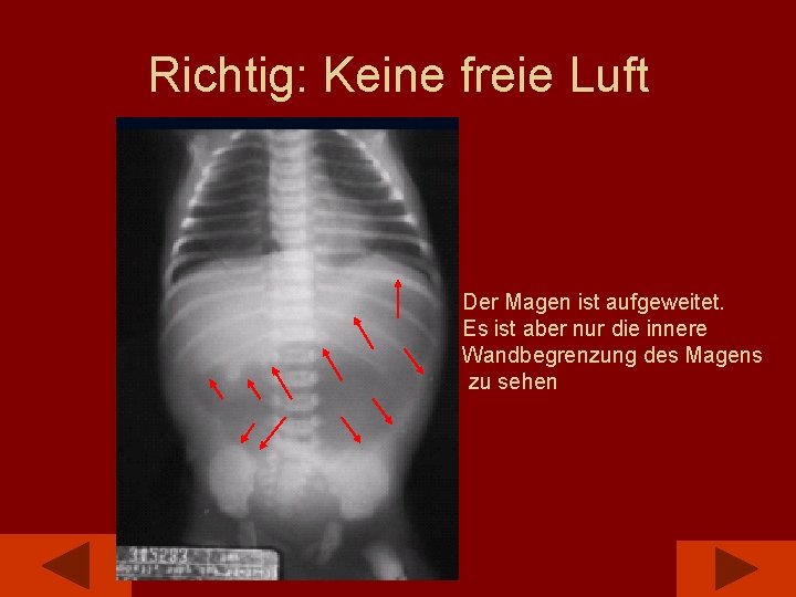 Richtig: Keine freie Luft Der Magen ist aufgeweitet. Es ist aber nur die innere