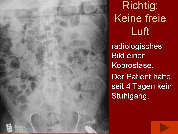 Richtig: Keine freie Luft • radiologisches Bild einer Koprostase. • Der Patient hatte seit