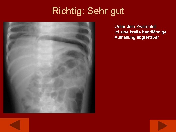Richtig: Sehr gut Unter dem Zwerchfell ist eine breite bandförmige Aufhellung abgrenzbar 