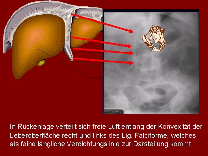 In Rückenlage verteilt sich freie Luft entlang der Konvexität der Leberoberfläche recht und links