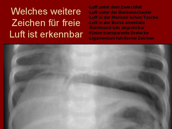 Welches weitere Zeichen für freie Luft ist erkennbar • Luft unter dem Zwerchfell •