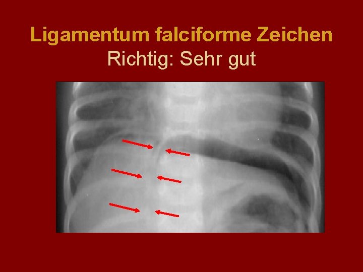 Ligamentum falciforme Zeichen Richtig: Sehr gut 