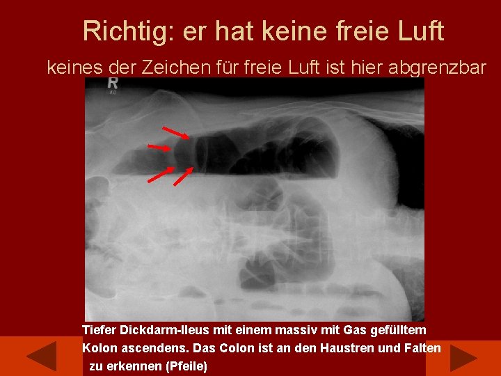 Richtig: er hat keine freie Luft keines der Zeichen für freie Luft ist hier