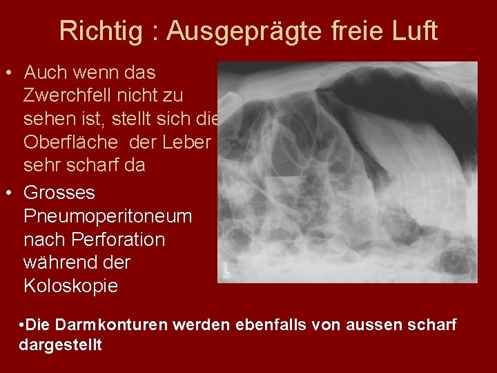 Richtig : Ausgeprägte freie Luft • Auch wenn das Zwerchfell nicht zu sehen ist,
