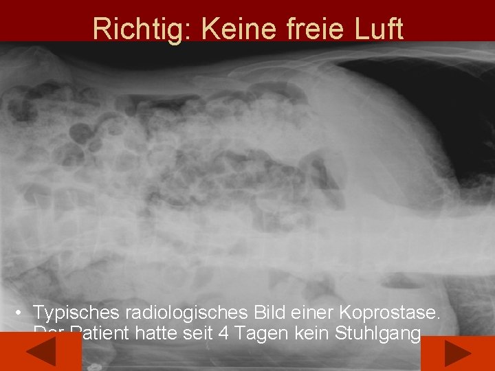 Richtig: Keine freie Luft • Typisches radiologisches Bild einer Koprostase. Der Patient hatte seit
