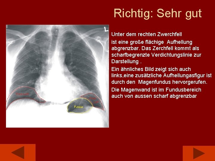 Richtig: Sehr gut Unter dem rechten Zwerchfell ist eine große flächige Aufhellung abgrenzbar. Das