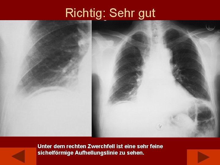 Richtig: Sehr gut Unter dem rechten Zwerchfell ist eine sehr feine sichelförmige Aufhellungslinie zu