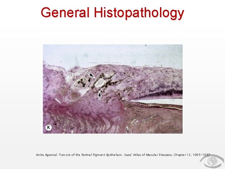 General Histopathology Anita Agarwal. Tumors of the Retinal Pigment Epithelium. Gass’ Atlas of Macular