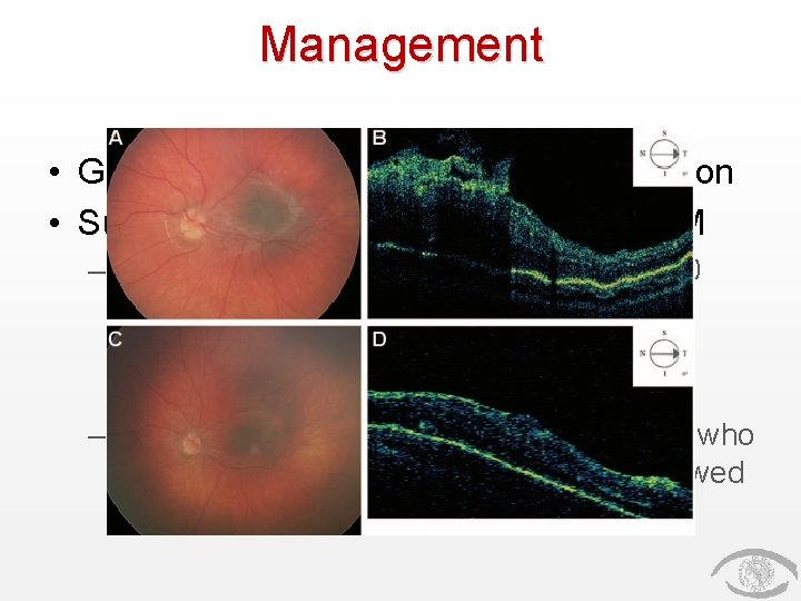 Management • General Treatment: amblyopia prevention • Surgical Treatment: Vitrectomy for ERM – Schachat