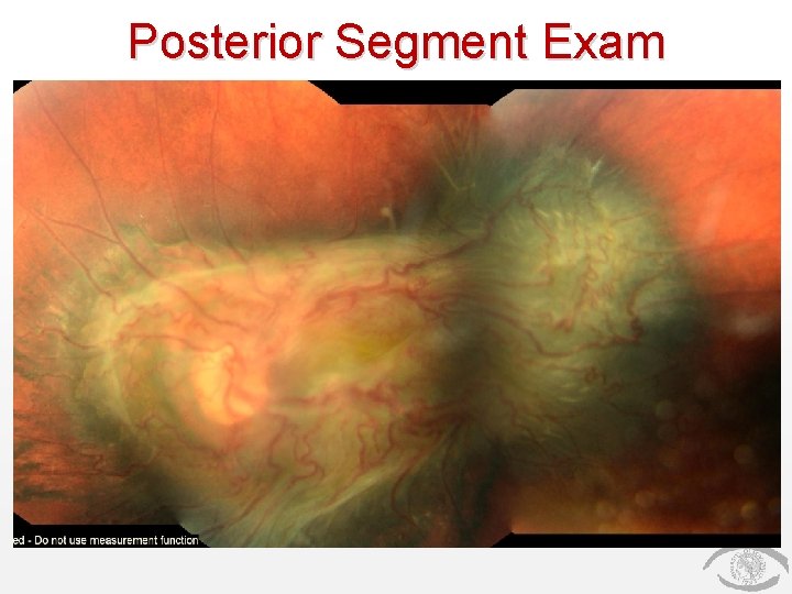 Posterior Segment Exam 