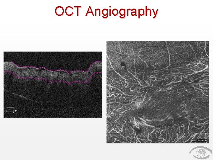 OCT Angiography 
