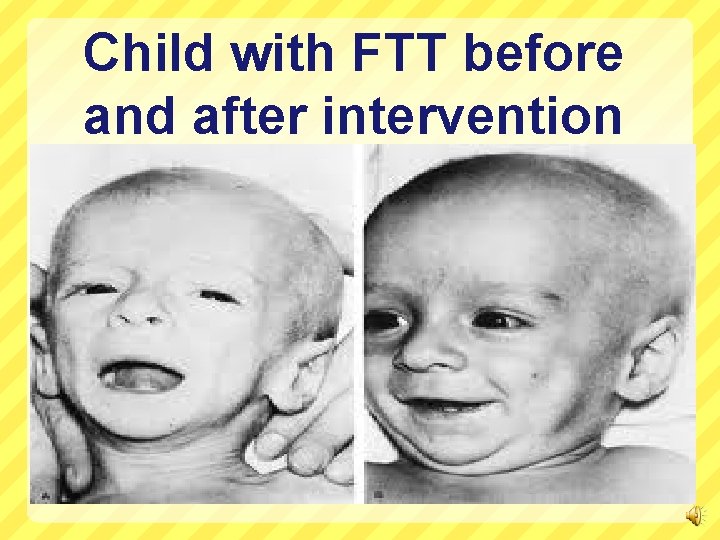 Child with FTT before and after intervention 