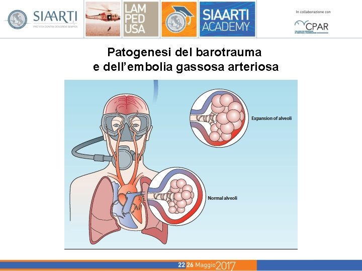 Patogenesi del barotrauma e dell’embolia gassosa arteriosa 