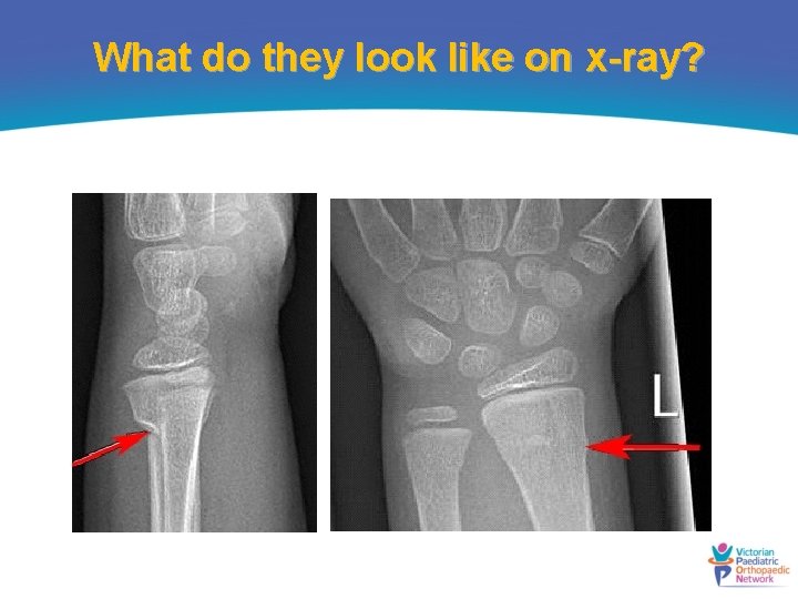 What do they look like on x-ray? 