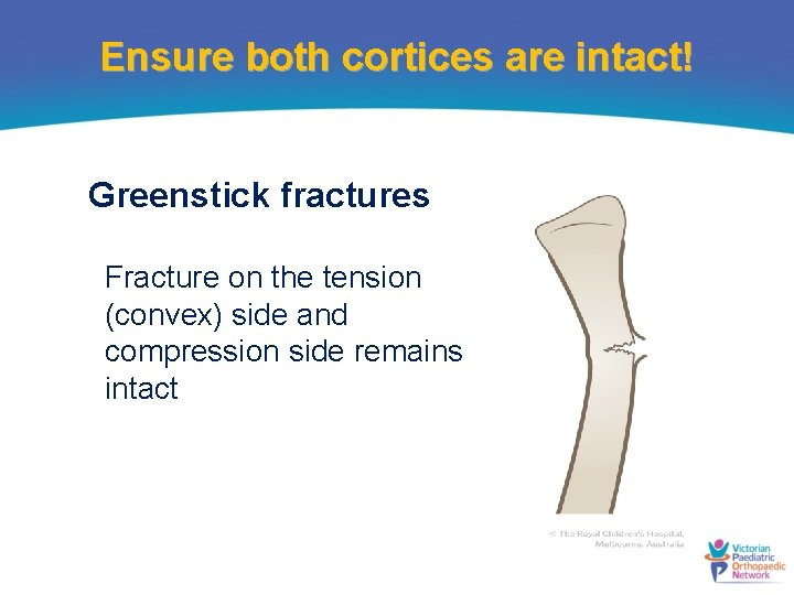 Ensure both cortices are intact! Greenstick fractures Fracture on the tension (convex) side and