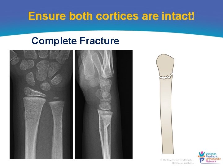 Ensure both cortices are intact! Complete Fracture 