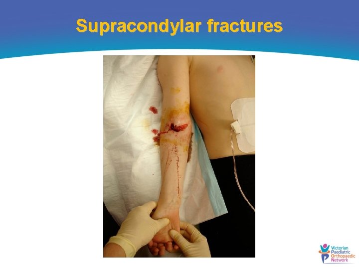 Supracondylar fractures 