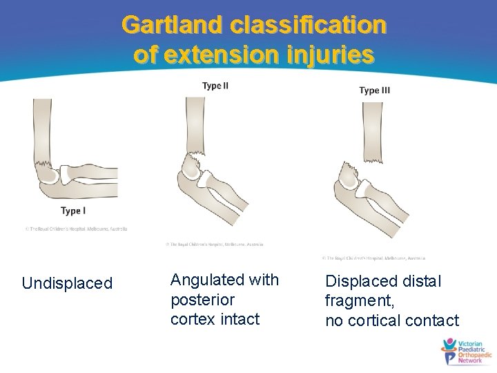 Gartland classification of extension injuries Undisplaced Angulated with posterior cortex intact Displaced distal fragment,