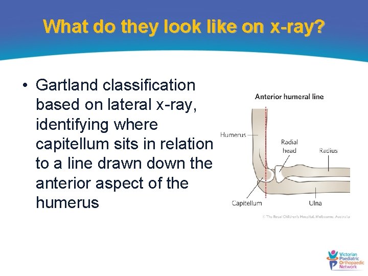 What do they look like on x-ray? • Gartland classification based on lateral x-ray,