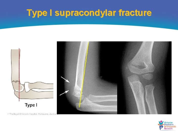 Type I supracondylar fracture 