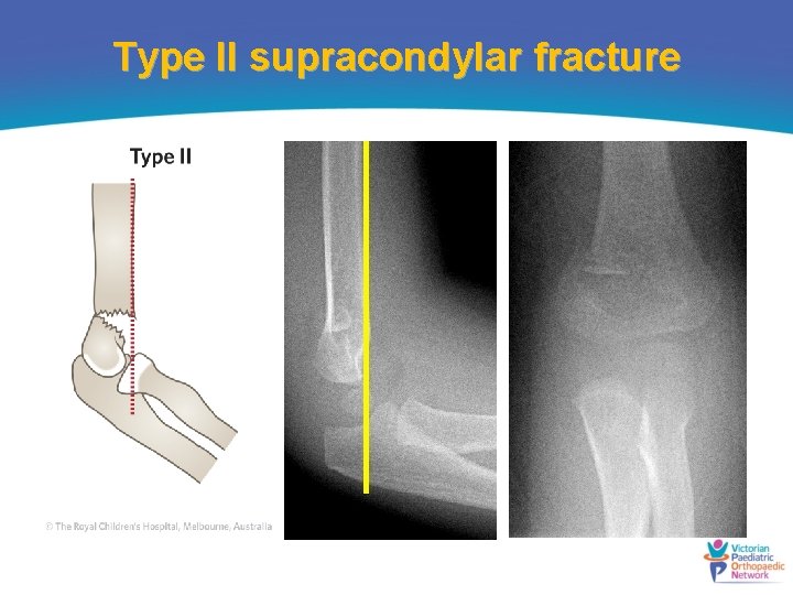 Type II supracondylar fracture 