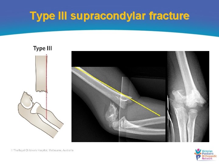 Type III supracondylar fracture 