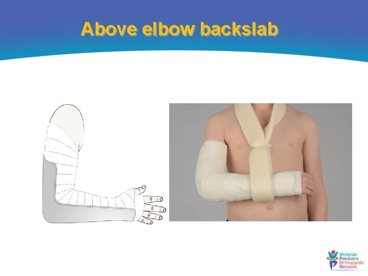 Above elbow backslab 