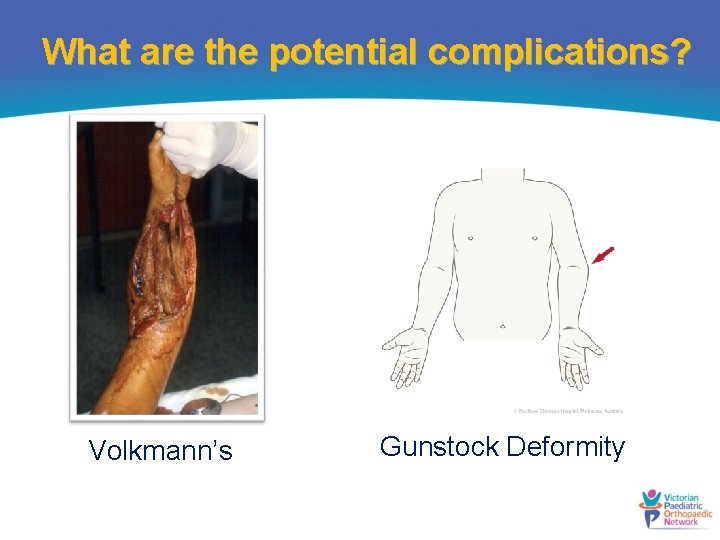 What are the potential complications? Volkmann’s Gunstock Deformity 