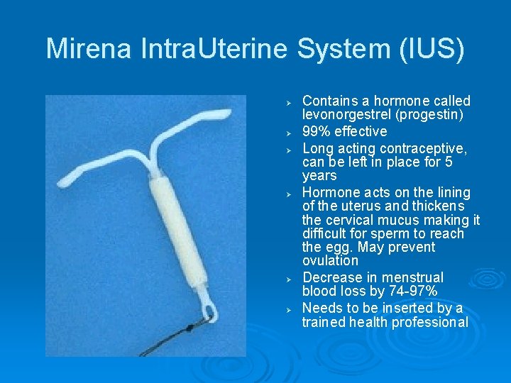 Mirena Intra. Uterine System (IUS) Ø Ø Ø Contains a hormone called levonorgestrel (progestin)