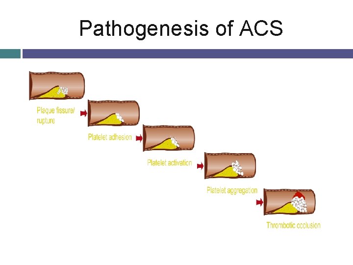 Pathogenesis of ACS 