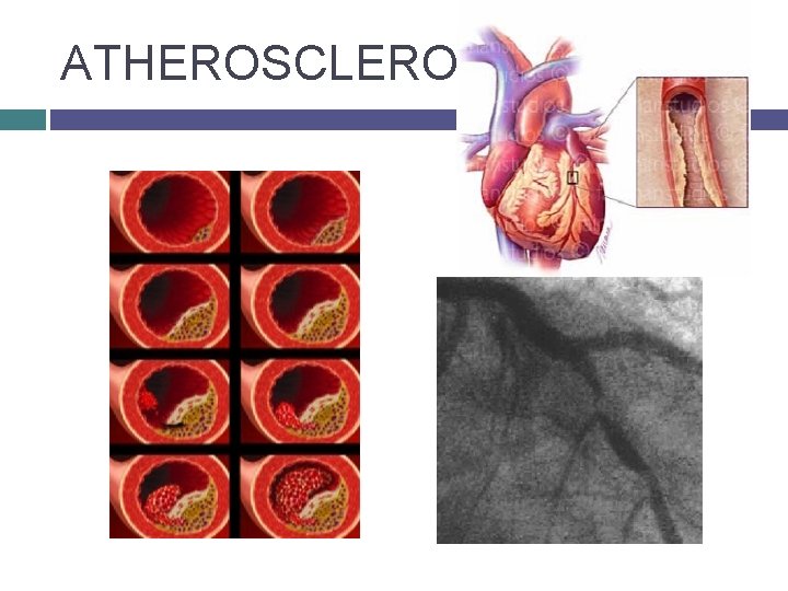 ATHEROSCLEROSIS 
