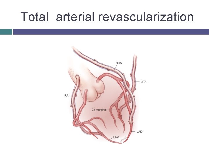 Total arterial revascularization 