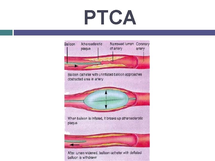 PTCA 