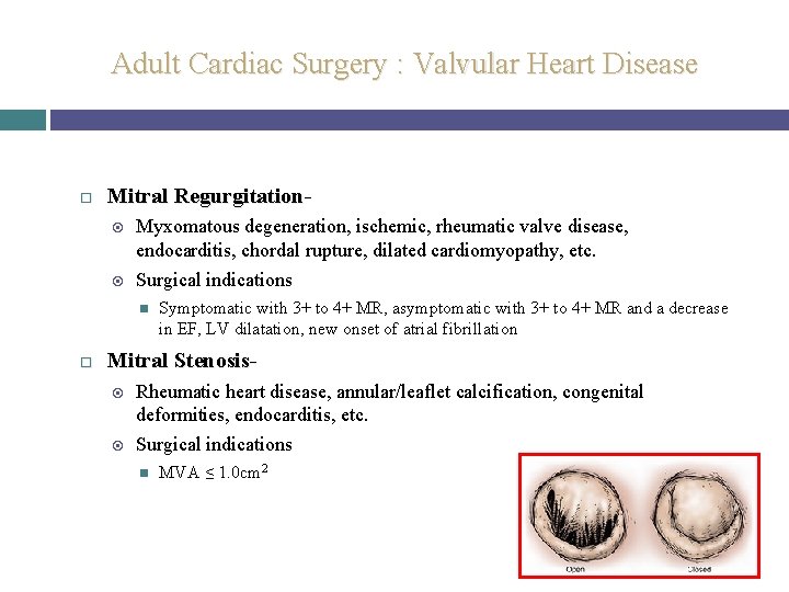 Adult Cardiac Surgery : Valvular Heart Disease Mitral Regurgitation Myxomatous degeneration, ischemic, rheumatic valve