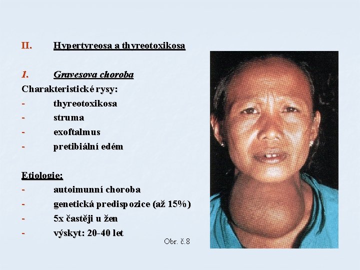 II. Hypertyreosa a thyreotoxikosa 1. Gravesova choroba Charakteristické rysy: thyreotoxikosa struma exoftalmus pretibiální edém