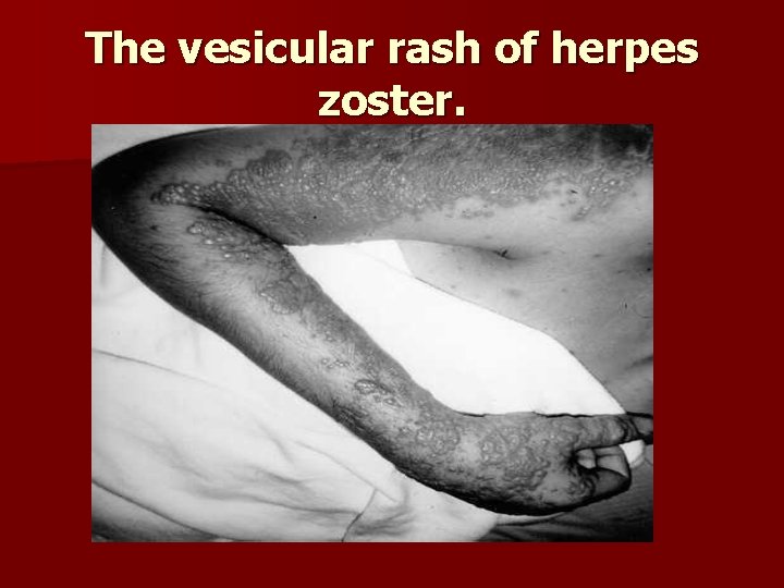 The vesicular rash of herpes zoster. 
