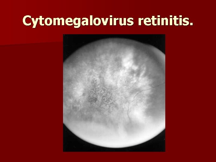 Cytomegalovirus retinitis. 