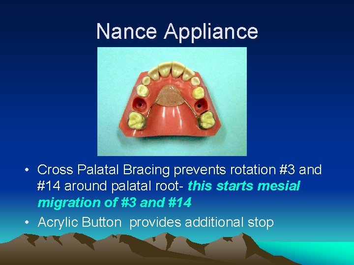 Nance Appliance • Cross Palatal Bracing prevents rotation #3 and #14 around palatal root-