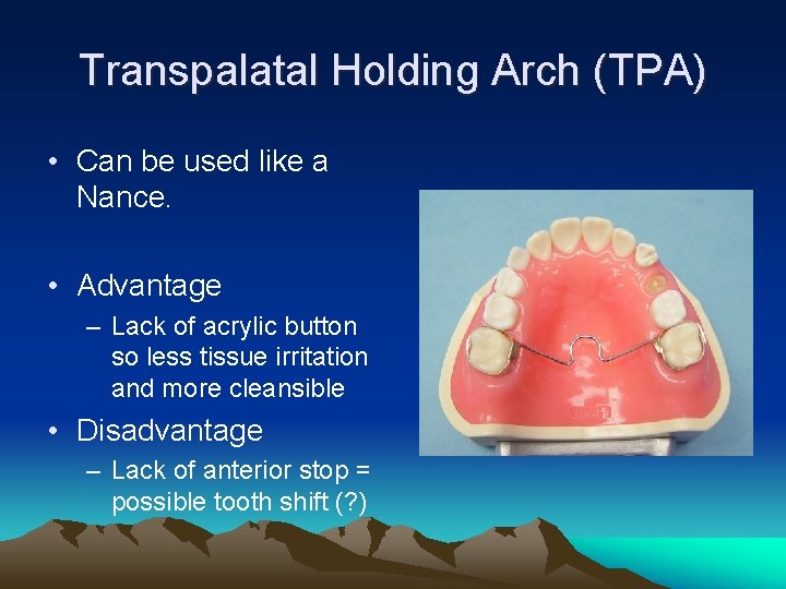 Transpalatal Holding Arch (TPA) • Can be used like a Nance. • Advantage –