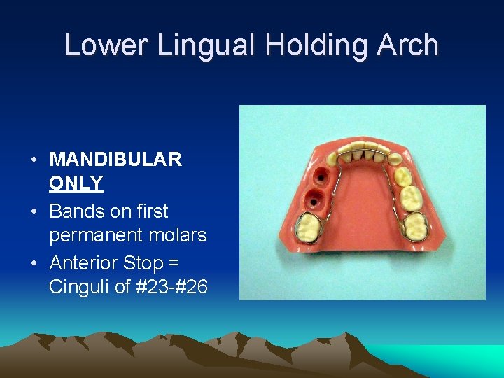Lower Lingual Holding Arch • MANDIBULAR ONLY • Bands on first permanent molars •