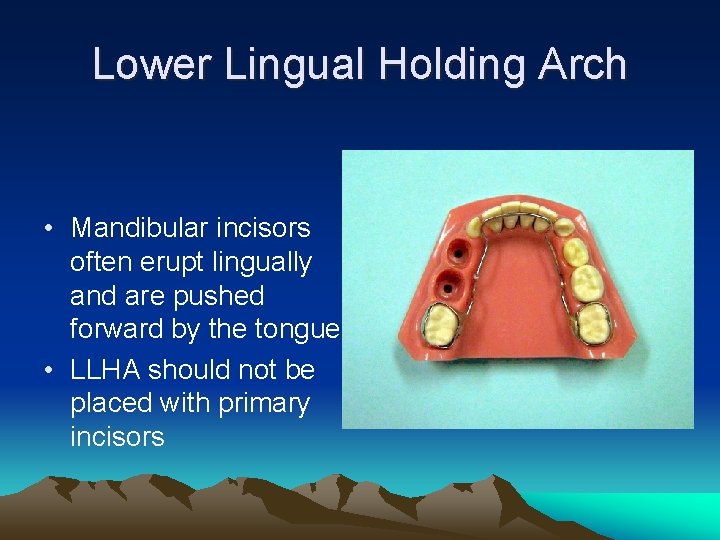 Lower Lingual Holding Arch • Mandibular incisors often erupt lingually and are pushed forward