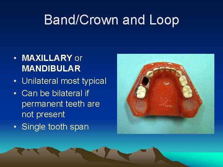 Band/Crown and Loop • MAXILLARY or MANDIBULAR • Unilateral most typical • Can be