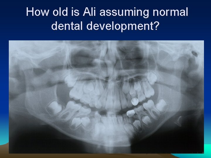 How old is Ali assuming normal dental development? 
