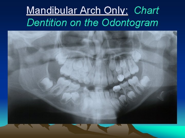 Mandibular Arch Only: Chart Dentition on the Odontogram 